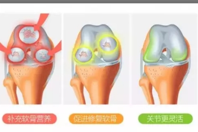 氨糖的作用保护关节靠谱吗？能够起到哪些作用？