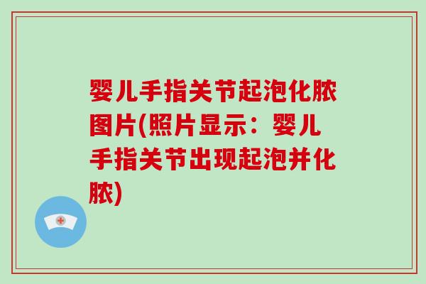 婴儿手指关节起泡化脓图片(照片显示:婴儿手指关节出现起泡并化脓) 婴儿手指关节起泡化脓图片(照片显示:婴儿手指关节出现起泡并化脓)