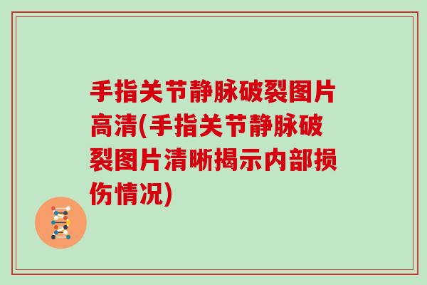 手指关节静脉破裂图片高清(手指关节静脉破裂图片清晰揭示内部损伤情况) 手指关节静脉破裂图片高清(手指关节静脉破裂图片清晰揭示内部损伤情况)