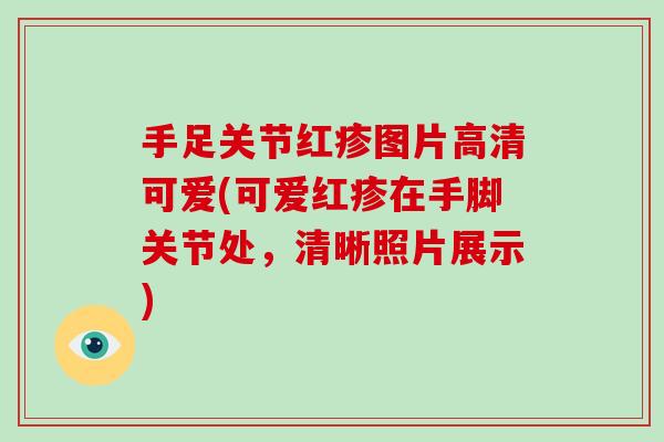 手足关节红疹图片高清可爱(可爱红疹在手脚关节处,清晰照片展示) 手足关节红疹图片高清可爱(可爱红疹在手脚关节处,清晰照片展示)