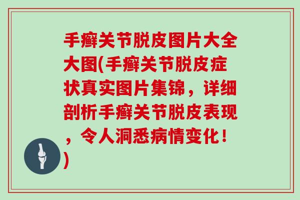 手癣关节脱皮图片大全大图(手癣关节脱皮症状真实图片集锦,详细剖析手癣关节脱皮表现,令人洞悉情变化!) 手癣关节脱皮图片大全大图(手癣关节脱皮症状真实图片集锦,详细剖析手癣关节脱皮表现,令人洞悉情变化!)